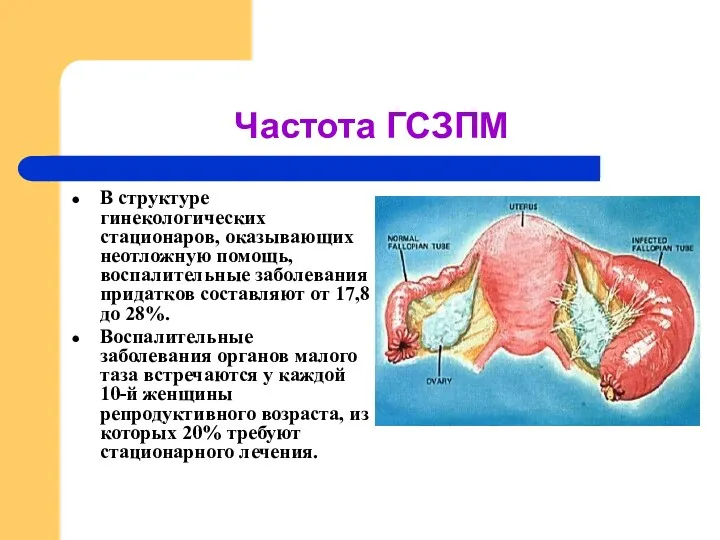 Частота ГСЗПМ В структуре гинекологических стационаров, оказывающих неотложную помощь, воспалительные