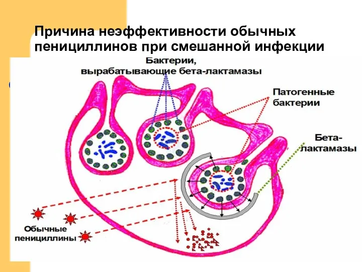 Причина неэффективности обычных пенициллинов при смешанной инфекции