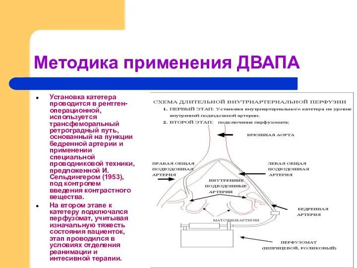 Методика применения ДВАПА Установка катетера проводится в рентген- операционной, используется