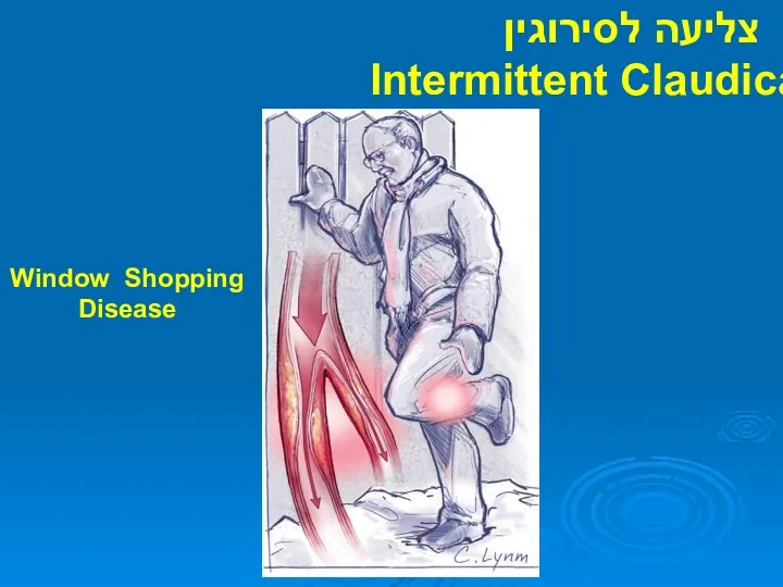 צליעה לסירוגין Intermittent Claudication Window Shopping Disease