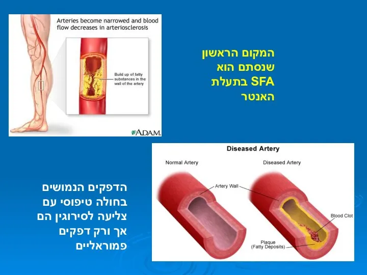 המקום הראשון שנסתם הוא SFA בתעלת האנטר הדפקים הנמושים בחולה