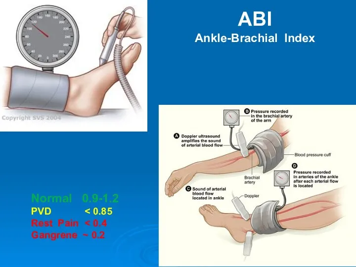 Normal 0.9-1.2 PVD Rest Pain Gangrene ~ 0.2 ABI Ankle-Brachial Index