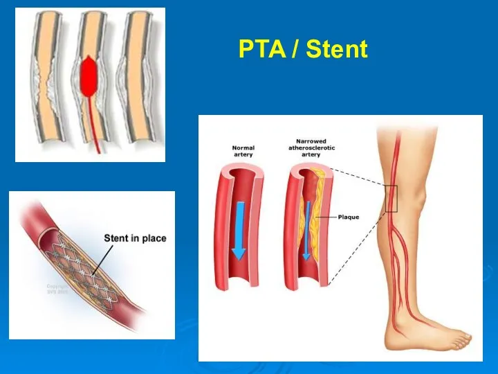 PTA / Stent