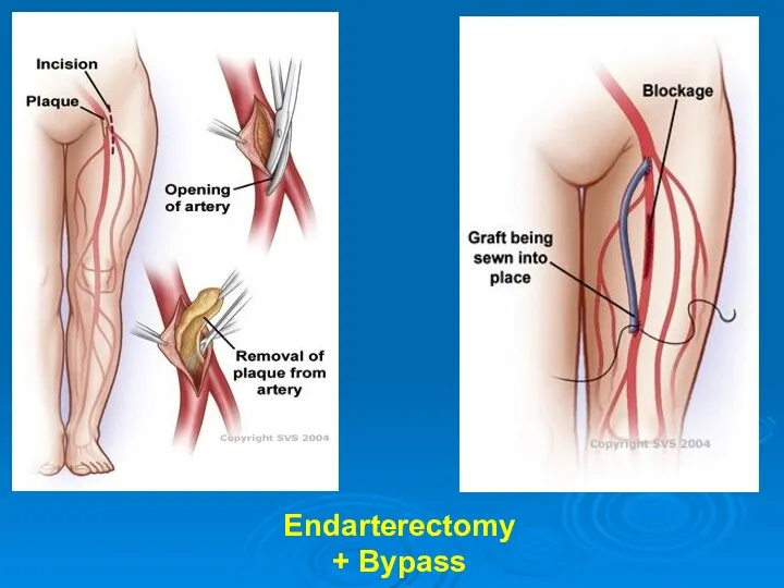 Endarterectomy + Bypass