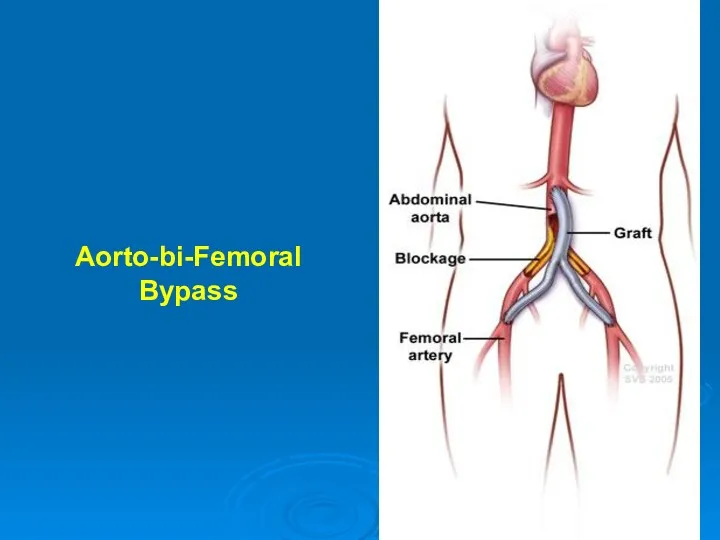 Aorto-bi-Femoral Bypass