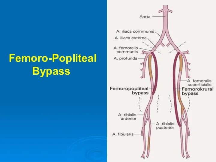 Femoro-Popliteal Bypass