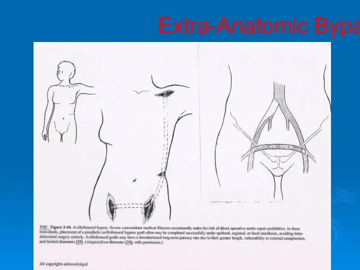 Extra-Anatomic Bypass