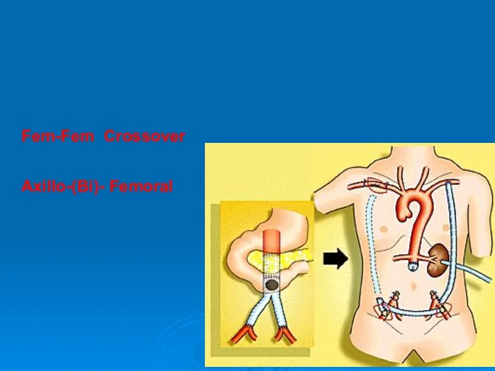 Fem-Fem Crossover Axillo-(Bi)- Femoral