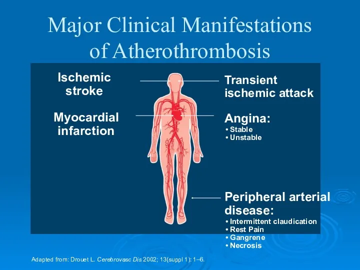 Major Clinical Manifestations of Atherothrombosis Adapted from: Drouet L. Cerebrovasc