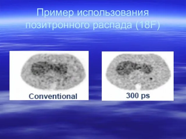 Пример использования позитронного распада (18F)‏