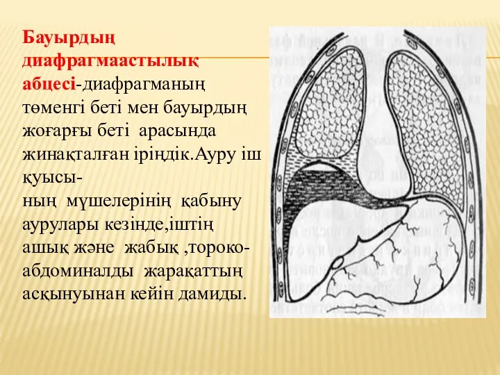 Бауырдың диафрагмаастылық абцесі-диафрагманың төменгі беті мен бауырдың жоғарғы беті арасында жинақталған іріңдік.Ауру іш