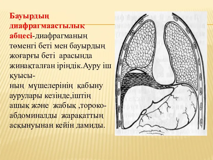 Бауырдың диафрагмаастылық абцесі-диафрагманың төменгі беті мен бауырдың жоғарғы беті арасында