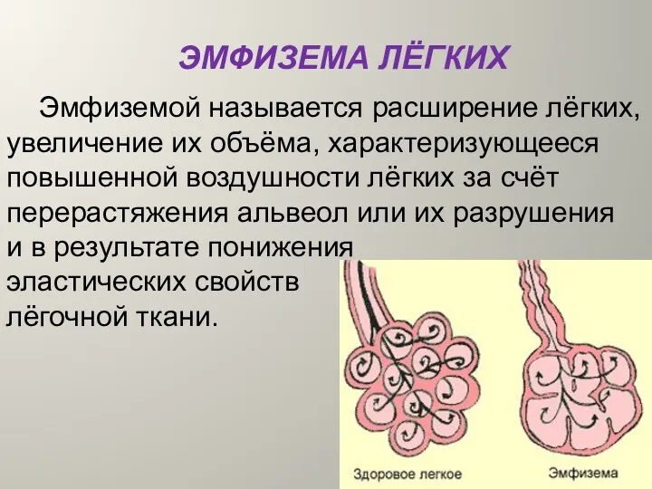 ЭМФИЗЕМА ЛЁГКИХ Эмфиземой называется расширение лёгких, увеличение их объёма, характеризующееся