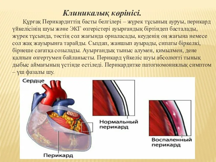 Клиникалық көрінісі. Құрғақ Перикардиттің басты белгілері – жүрек тұсының ауруы,