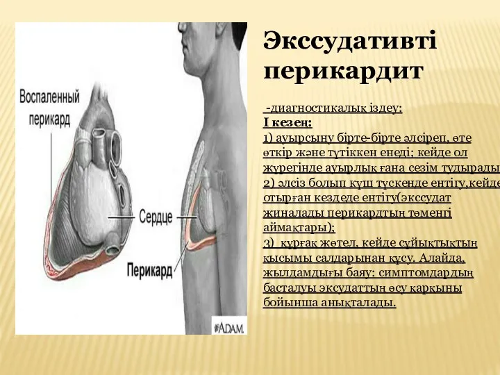 Экссудативті перикардит -диагностикалық іздеу: I кезең: 1) ауырсыну бірте-бірте әлсіреп,