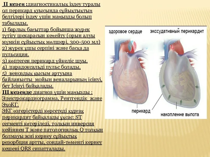 II кезең :диагностикалық іздеу туралы ол перикард қуысында сұйықтықтың белгілері