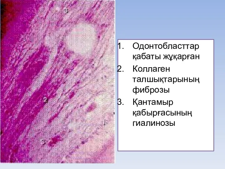 Одонтобласттар қабаты жұқарған Коллаген талшықтарының фиброзы Қантамыр қабырғасының гиалинозы