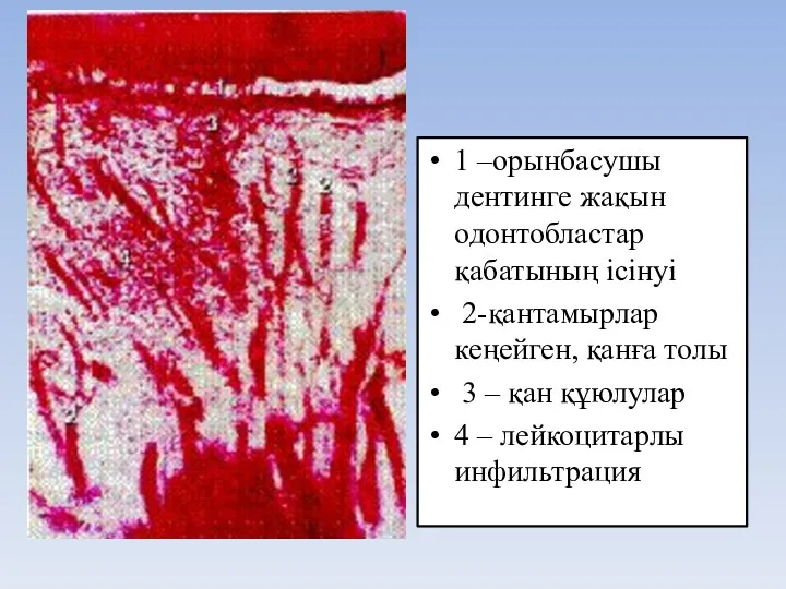 1 –орынбасушы дентинге жақын одонтобластар қабатының ісінуі 2-қантамырлар кеңейген, қанға