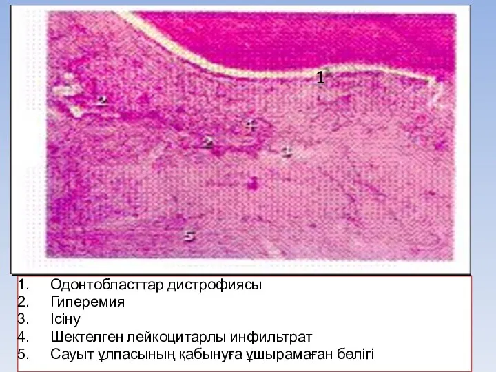 Одонтобласттар дистрофиясы Гиперемия Ісіну Шектелген лейкоцитарлы инфильтрат Сауыт ұлпасының қабынуға ұшырамаған бөлігі 1