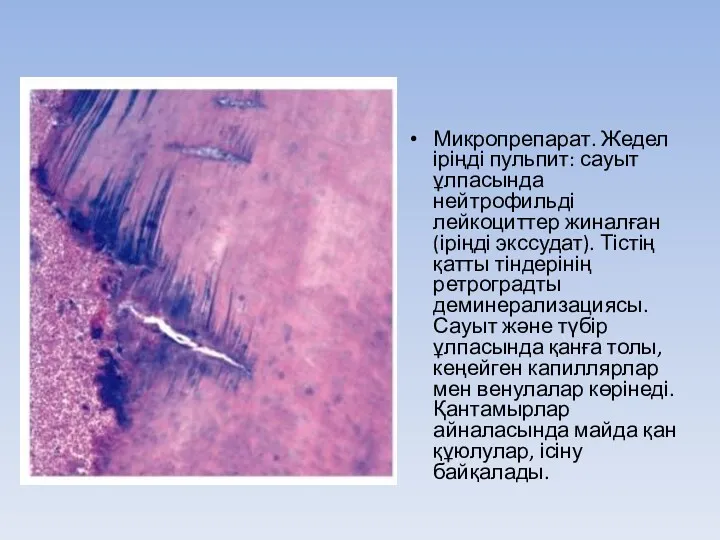 Микропрепарат. Жедел іріңді пульпит: сауыт ұлпасында нейтрофильді лейкоциттер жиналған(іріңді экссудат).