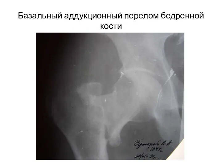 Базальный аддукционный перелом бедренной кости