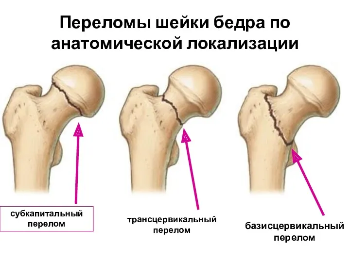 Переломы шейки бедра по анатомической локализации субкапитальный перелом трансцервикальный перелом базисцервикальный перелом