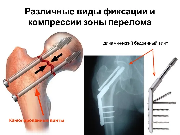 Различные виды фиксации и компрессии зоны перелома динамический бедренный винт Канюлированные винты