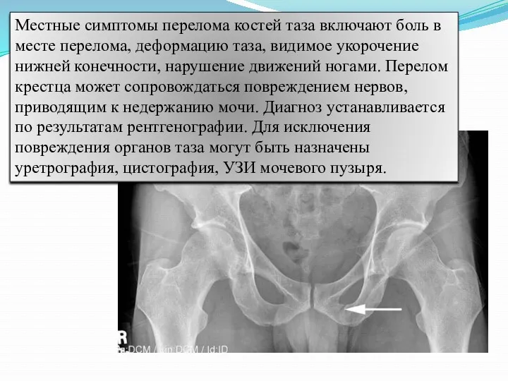 Местные симптомы перелома костей таза включают боль в месте перелома,