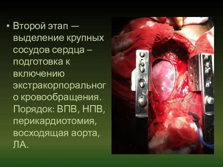 Второй этап — выделение крупных сосудов сердца – подготовка к включению экстракорпорального кровообращения.