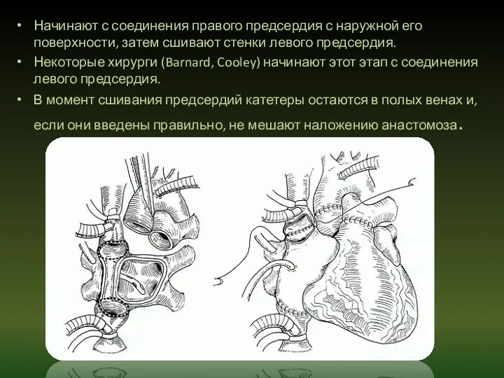 Начинают с соединения правого предсердия с наружной его поверхности, затем сшивают стенки левого