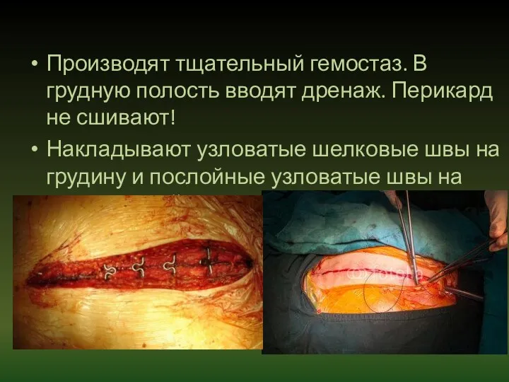 Производят тщательный гемостаз. В грудную полость вводят дренаж. Перикард не сшивают! Накладывают узловатые
