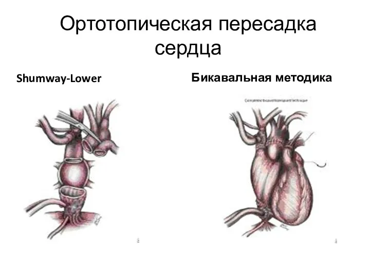 Shumway-Lower Бикавальная методика Ортотопическая пересадка сердца