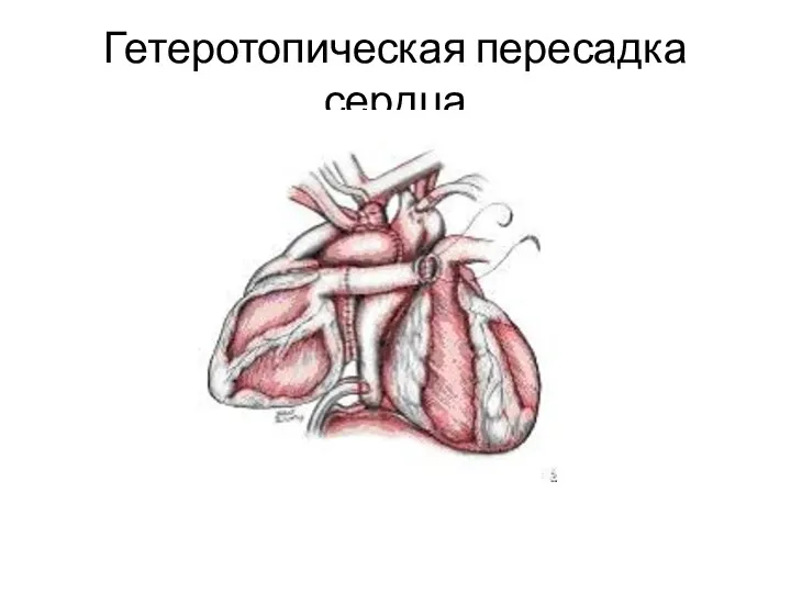 Гетеротопическая пересадка сердца