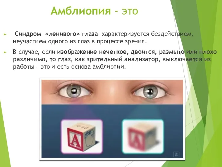 Амблиопия - это Синдром «ленивого» глаза характеризуется бездействием, неучастием одного