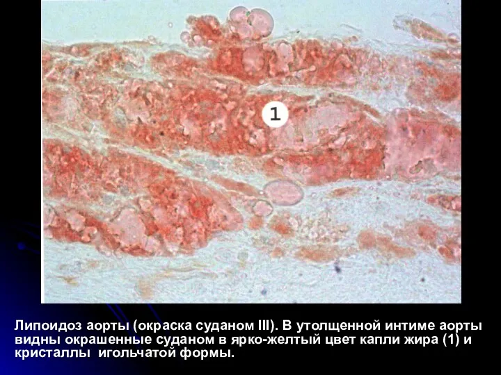 Липоидоз аорты (окраска суданом III). В утолщенной интиме аорты видны