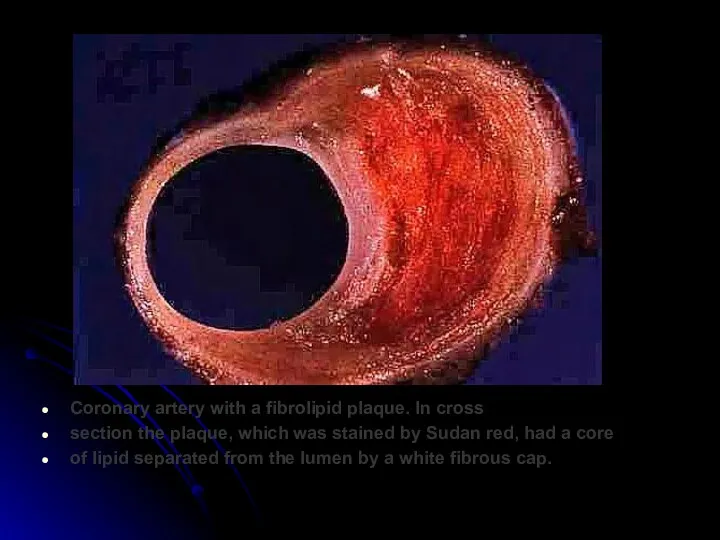 Coronary artery with a fibrolipid plaque. In cross section the