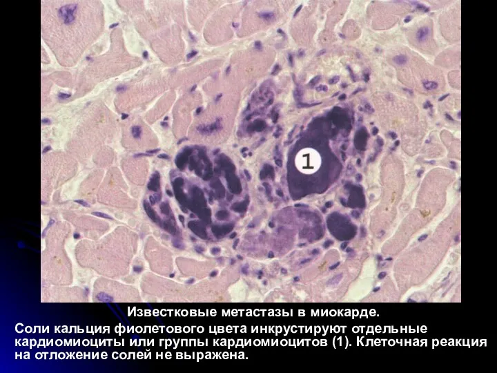 Известковые метастазы в миокарде. Соли кальция фиолетового цвета инкрустируют отдельные