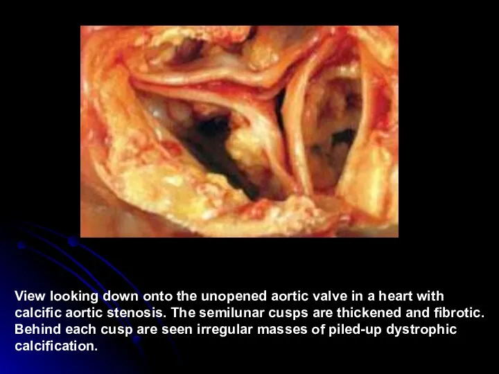 View looking down onto the unopened aortic valve in a
