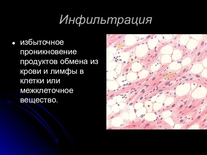 Инфильтрация избыточное проникновение продуктов обмена из крови и лимфы в клетки или межклеточное вещество.