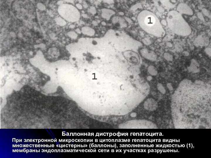 Баллонная дистрофия гепатоцита. При электронной микроскопии в цитоплазме гепатоцита видны