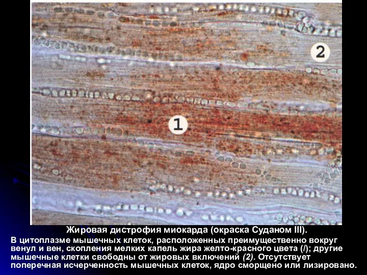 Жировая дистрофия миокарда (окраска Суданом III). В цитоплазме мышечных клеток,