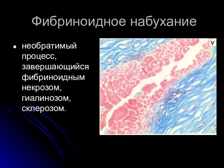 Фибриноидное набухание необратимый процесс, завершающийся фибриноидным некрозом, гиалинозом, склерозом.