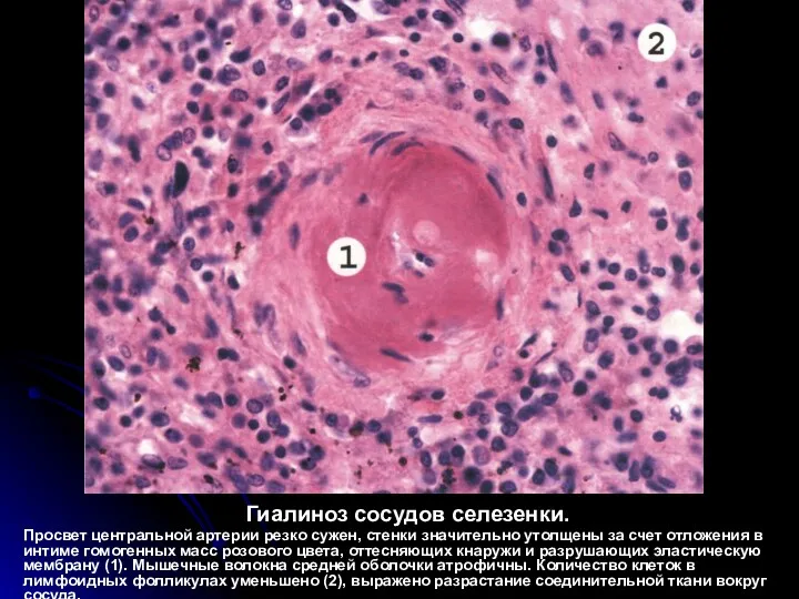 Гиалиноз сосудов селезенки. Просвет центральной артерии резко сужен, стенки значительно