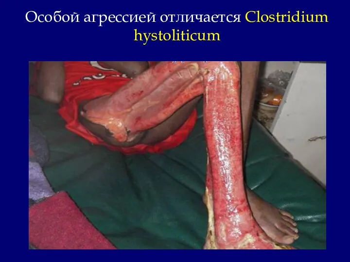 Особой агрессией отличается Clostridium hystoliticum