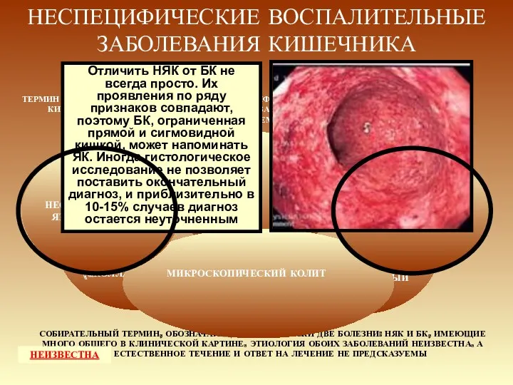 НЕСПЕЦИФИЧЕСКИЕ ВОСПАЛИТЕЛЬНЫЕ ЗАБОЛЕВАНИЯ КИШЕЧНИКА СОБИРАТЕЛЬНЫЙ ТЕРМИН, ОБОЗНАЧАЮЩИЙ ПРАКТИЧЕСКИ ДВЕ БОЛЕЗНИ: