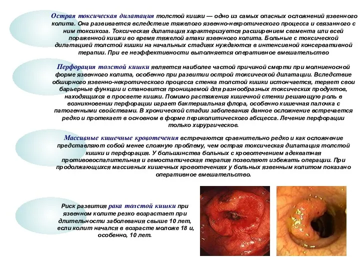 Острая токсическая дилатация толстой кишки — одно из самых опасных осложнений язвенного колита.