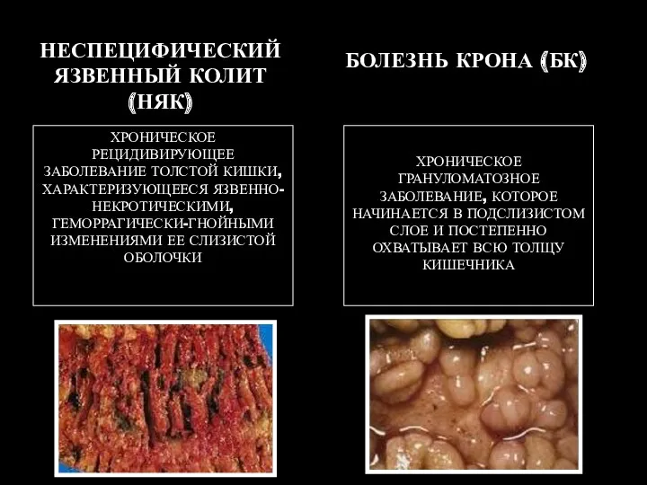 НЕСПЕЦИФИЧЕСКИЙ ЯЗВЕННЫЙ КОЛИТ (НЯК) ХРОНИЧЕСКОЕ РЕЦИДИВИРУЮЩЕЕ ЗАБОЛЕВАНИЕ ТОЛСТОЙ КИШКИ, ХАРАКТЕРИЗУЮЩЕЕСЯ