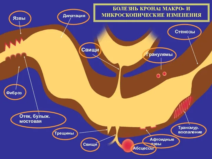 Язвы Отек, булыж.мостовая Фиброз Дилатация Свищи Гранулемы Стенозы Трансмур. воспаление Афтоидные язвы Абсцессы