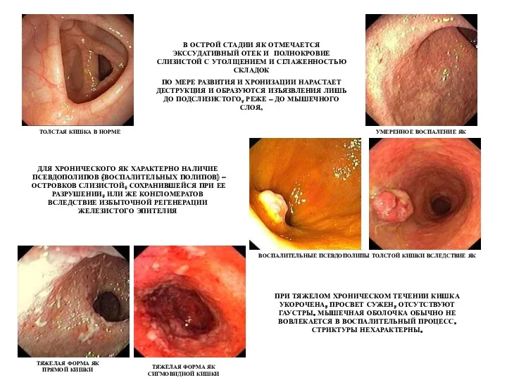 В ОСТРОЙ СТАДИИ ЯК ОТМЕЧАЕТСЯ ЭКССУДАТИВНЫЙ ОТЕК И ПОЛНОКРОВИЕ СЛИЗИСТОЙ С УТОЛЩЕНИЕМ И