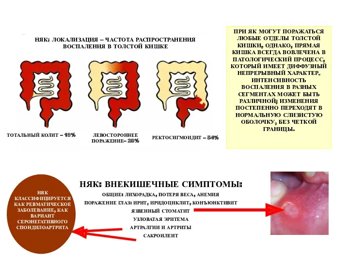НЯК: ЛОКАЛИЗАЦИЯ – ЧАСТОТА РАСПРОСТРАНЕНИЯ ВОСПАЛЕНИЯ В ТОЛСТОЙ КИШКЕ ТОТАЛЬНЫЙ